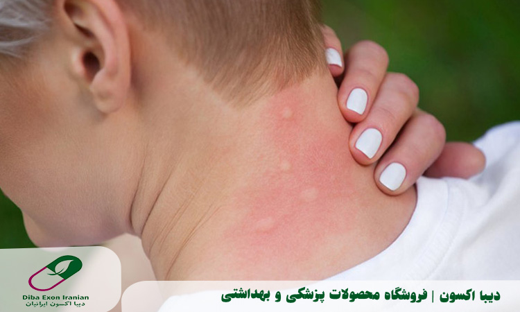 شناسایی انواع آلرژی و علائم آنها