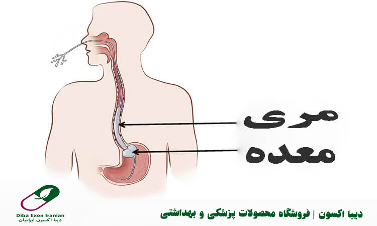 مراقبت های لازم از سوند معده
